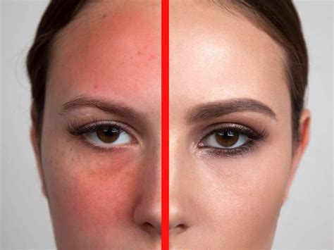 NATURAL REMEDIES FOR REDNESS ON THE FACE - Health GadgetsNG