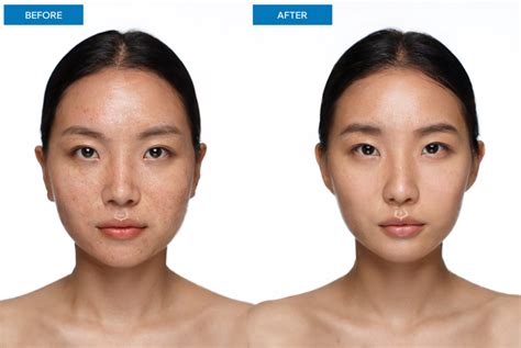 uneven skin texture treatment  sevenoaks prime aesthetics
