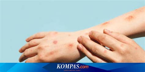 gejala cacar air  perlu diwaspadai