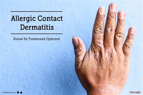 Allergic Contact Dermatitis - Know Its Treatment Options! - By Dr ...