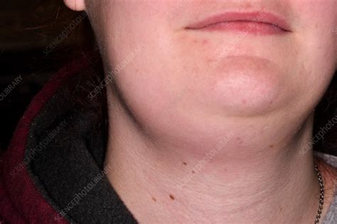 Rash And Swollen Lymph Nodes Causes Photos And Treatment