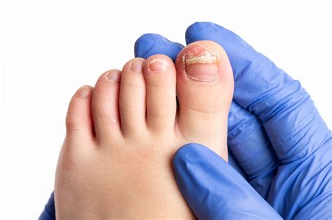 Диагностика и лечение грибка ногтей у детей | MedAboutMe