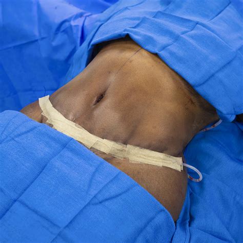 The Perfect Tummy Tuck & Belly Button | 305 Plastic Surgery