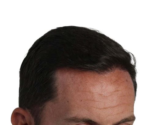 Como Saber Si Un Injerto Capilar A Agarrado 10