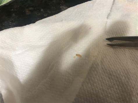 Trying to pop my moms huge blackhead : r/popping