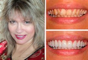 DR. SMILE съемные виниры