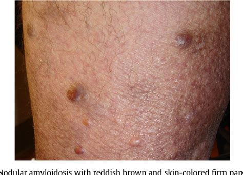 Table 1 from Cutaneous manifestations of multiple myeloma and other ...