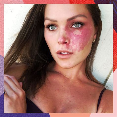 Port Wine Stain