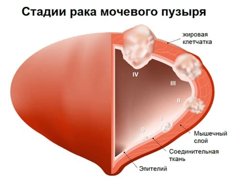 Лечение рака мочевого пузыря в Израиле | Манор Медикал Центр