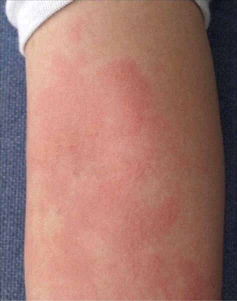Aquagenic Urticaria - Causes, Diagnosis, Facts and Treatment