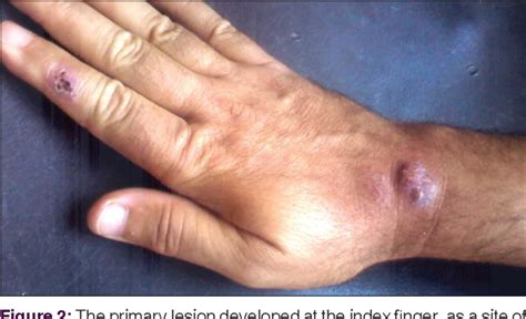 Figure 2 from Cutaneous sporotrichosis as an occupational disease: Case ...