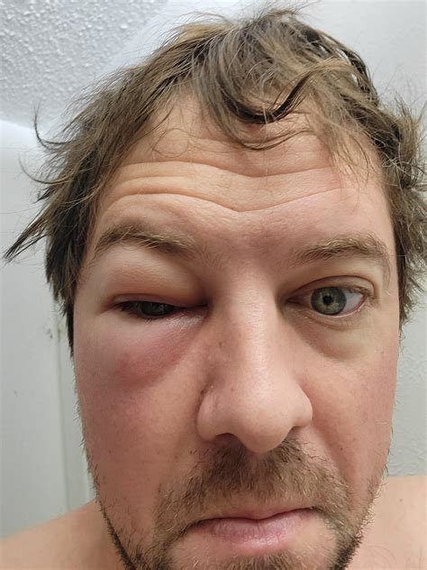 Bee Sting Face Swelling