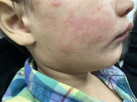 key facts  measles  protect  health