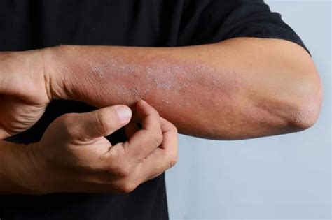 tanda tanda infeksi jamur  kulit  sembuh  sehat