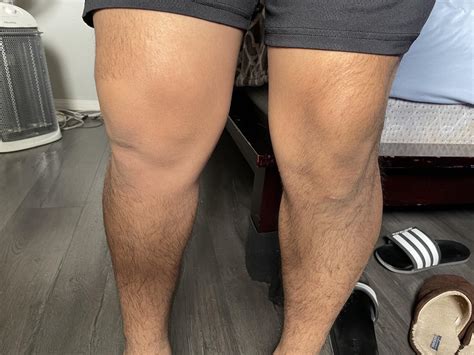 BPC-157 for sprained MCL: Recovery Log : r/Peptides