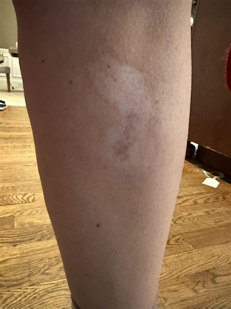 Was stung by jellyfish back in June, how to treat scarring? : r/jellyfish