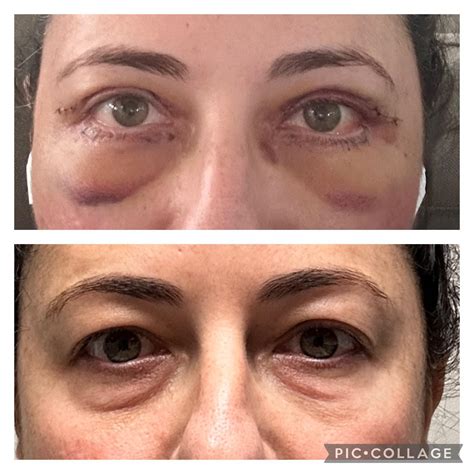 upper   bleph  days  rplasticsurgery