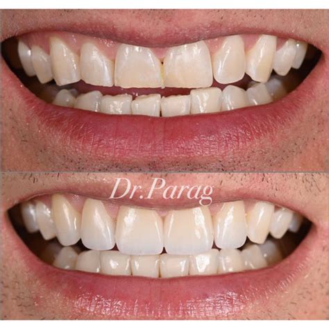 smile gallery elite smiles