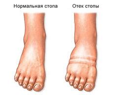 Лимфедема — симптомы, причины, лечение
