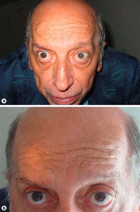 Right mydriasis, lid retraction and hyperhidrosis (a). Detail of right ...