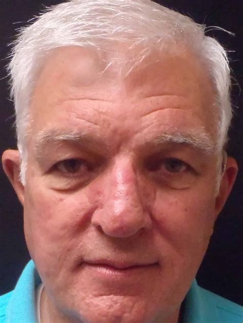 Rhinophyma Patient Testimonial - H/K/B Cosmetic Surgery in Oklahoma City