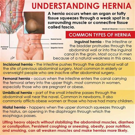 Funny Jokes LOL: understanding hernia