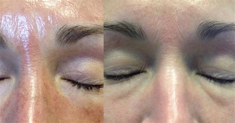 Elite Therapeutics Body and Skin Care: Jessner Peel