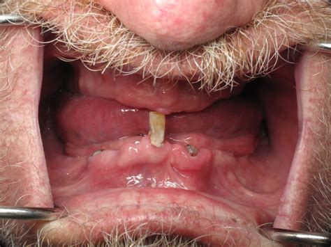 Bone Reduction Leveling For Dental Implants to Avoid a Bone Graft