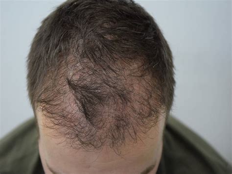 Androgena Alopecija | Telogeni Efluvijum | Trihotilomanija | Dermatim