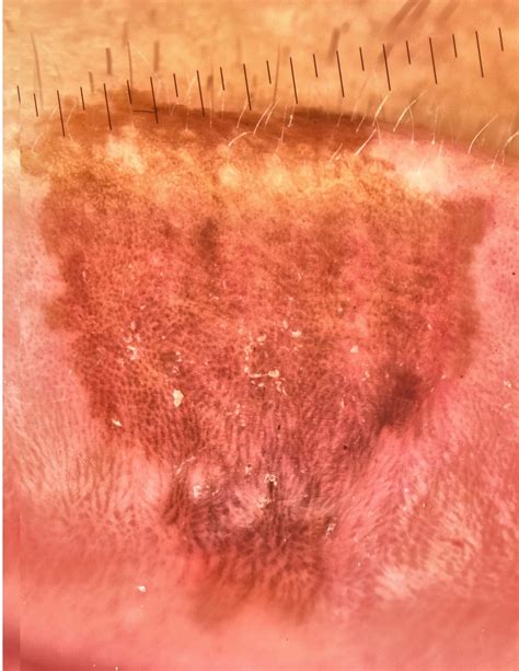 Taint melanotic of the lip vaporization laser – UNILASER MÉDICA