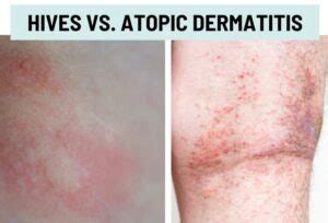 Hives (Urticaria) vs. Rash: Pictures and Differences