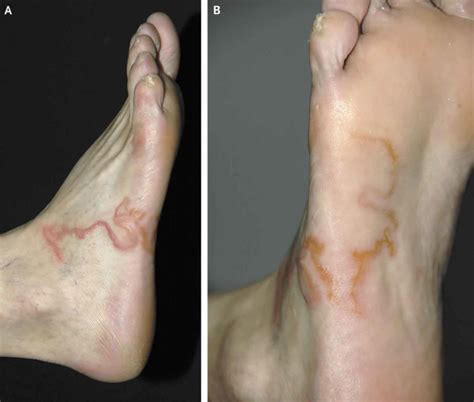 Cutaneous larva migrans causes, symptoms, diagnosis, treatment & prognosis