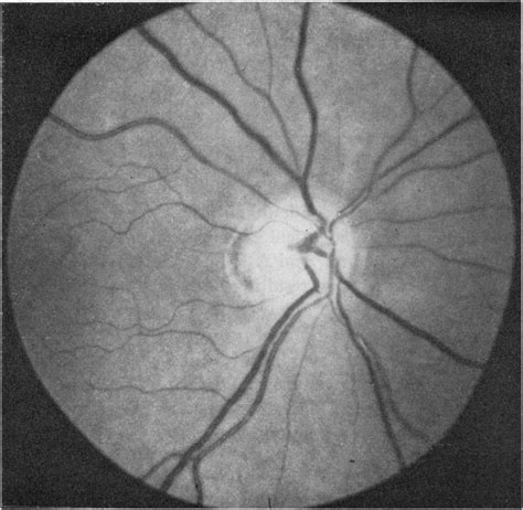 shows  optic disc   scientific diagram