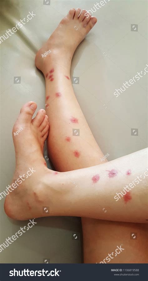 Allergy Symptom Many Red Rash Blister Stock Photo (Edit Now) 1106819588