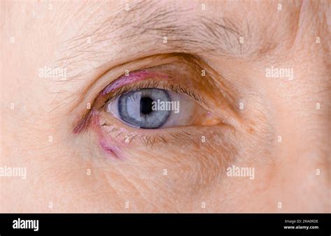 womans eye injured due  rupture  capillary causing hematoma