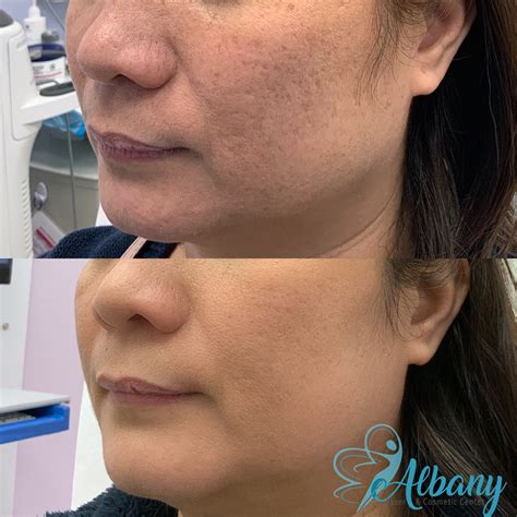 CO2 Laser Treatment in Edmonton | Albany Cosmetic Centre