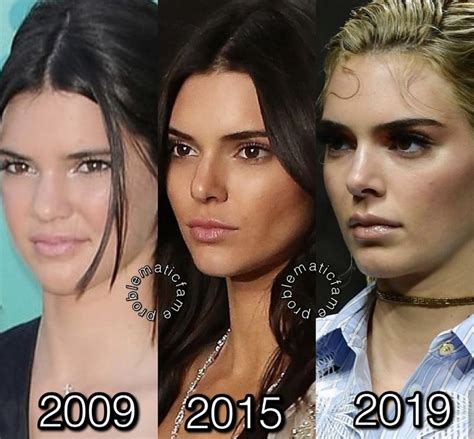Kendall Jenner Surgery, Get Taller Exercises, Nose Job, Kardashian ...