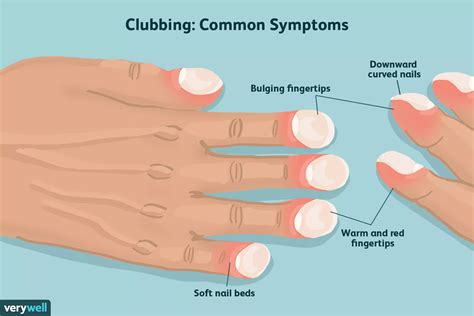 Psoriasis Help 4 Friends: Clubbing of the Fingers or Toes