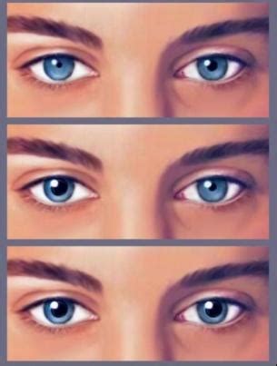 Abnormal Pupils - NEET PG Ophthamology - PrepLadder