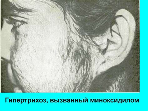 Гирсутизм и гипертрихоз - презентация онлайн