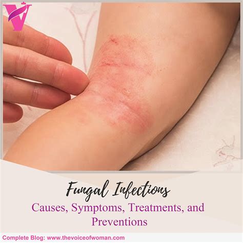 Fungal infections causes symptoms treatments and preventions – Artofit