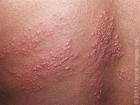 Shingles