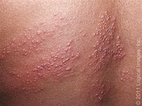 Shingles Rash African American