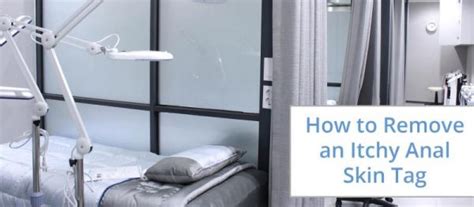 how to remove anal skin tag at home