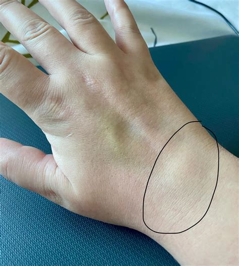 Swelling near wrist : r/rheumatoidarthritis