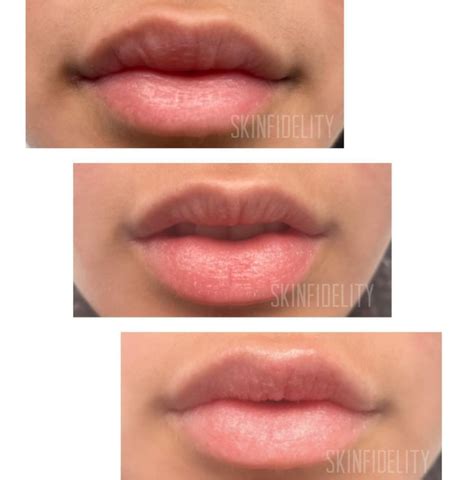 Botched Lip Filler Correction – SkinFidelity