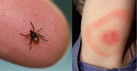 Everything That Happens to Your Body When You Get Lyme Disease