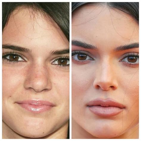 Plastic Surgery Kendall Jennercareer Detail Jenner Nose Job Boob Job ...