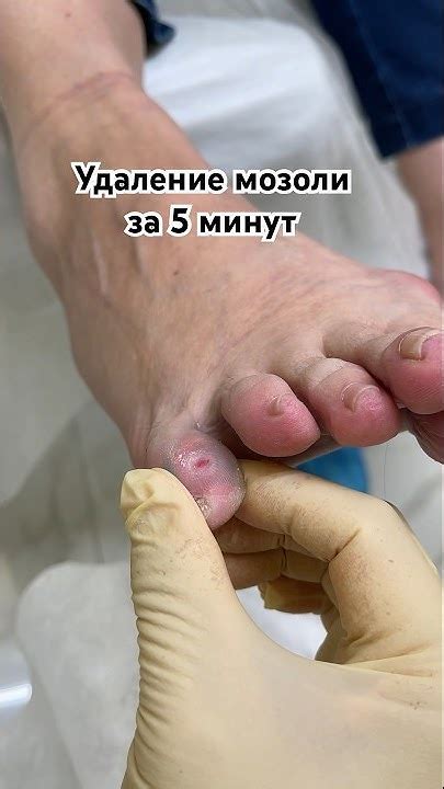 Стержневая мозоль между пальцами #мозоли #подологмосква #удалениемозоли ...