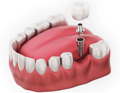 Snap-On Dentures Vs Al-On-4 Dental Implants